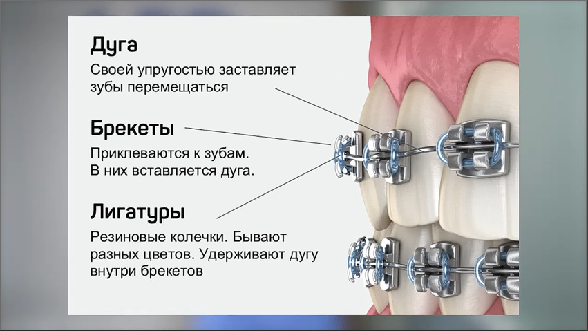 Брекет-система состоит из дуги, выравнивающей зубы, и фиксирующих замочков.